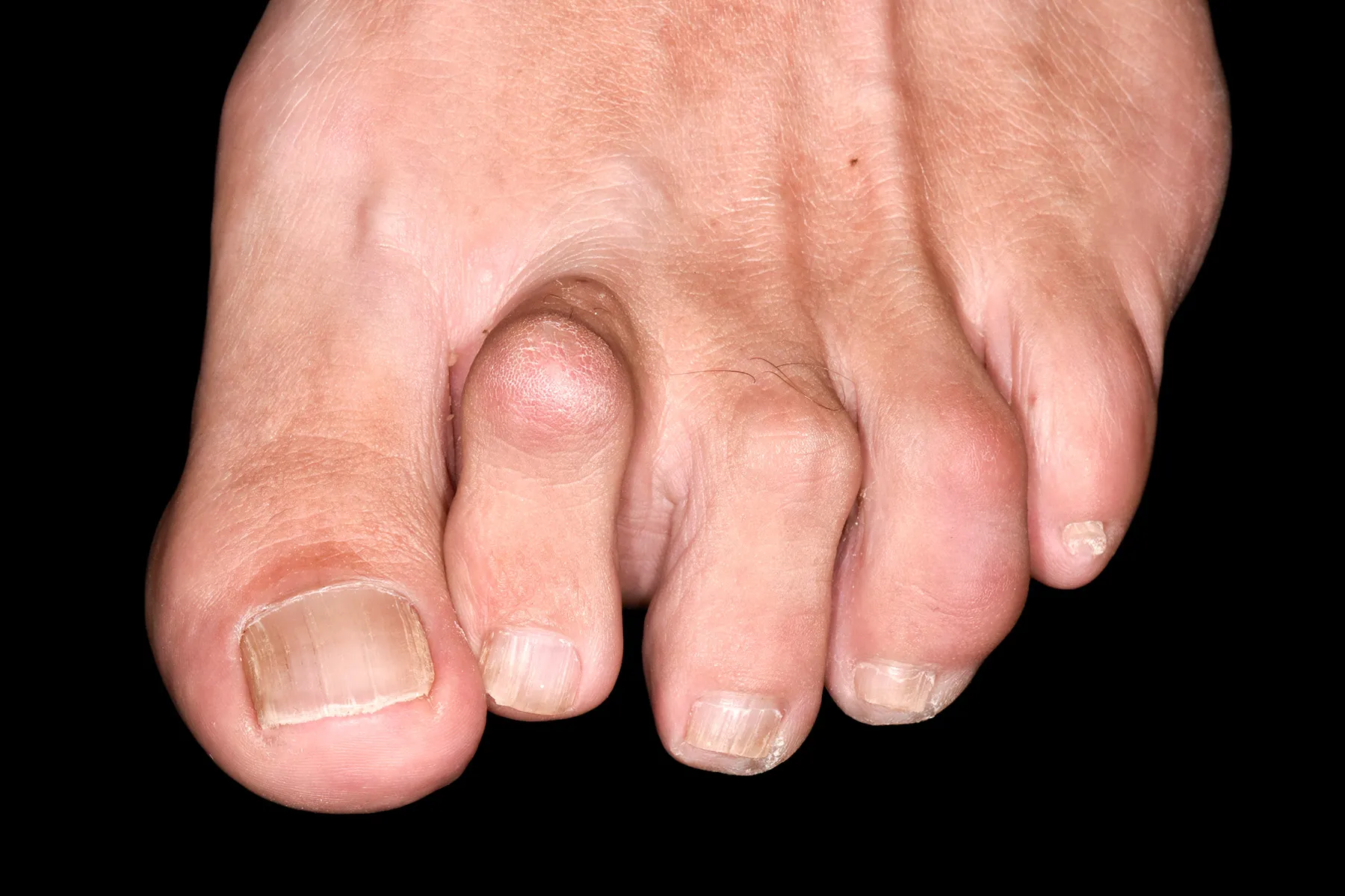 Hammertoe